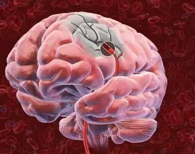 是大脑的某一根血管,发生了堵塞,造成脑组织缺氧,从而引发脑细胞的