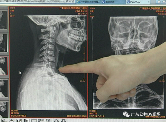 姑娘玩了一回过山车,脖子出现奇怪的变化!医生:严重可致瘫