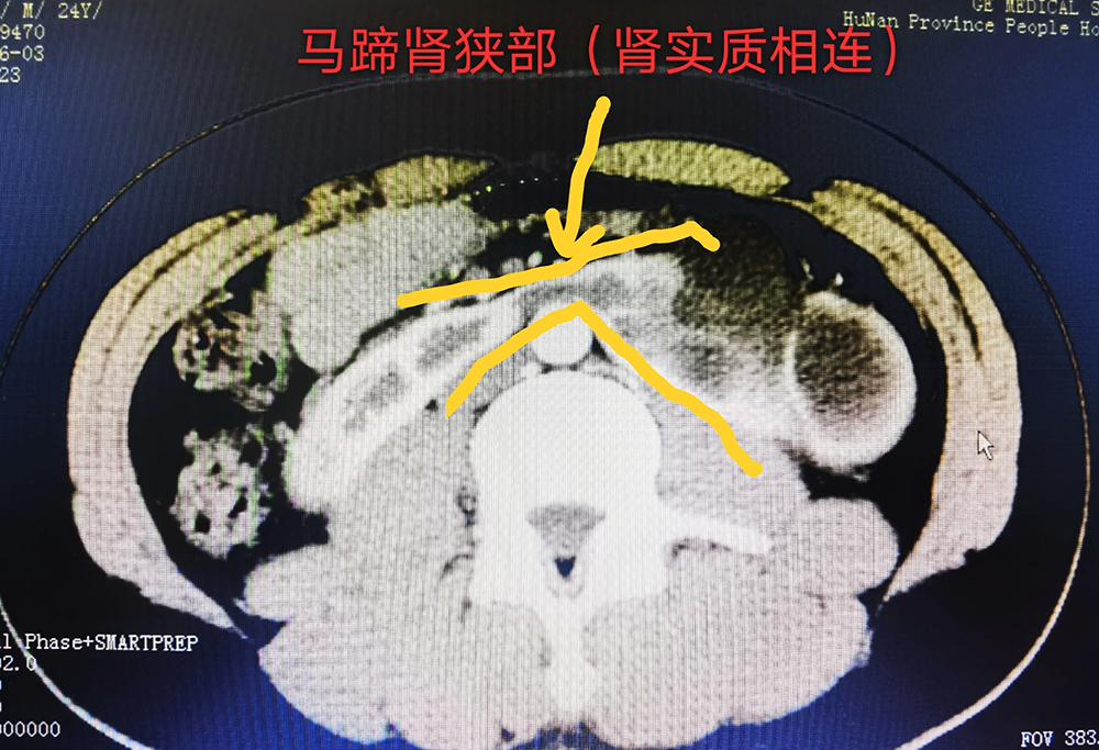 株洲一小伙腰痛两年直到婚检才发现是马蹄肾不得不叫停婚礼住进医院