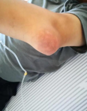 吃烧烤喝啤酒半夜胳膊肘红肿疼痛难忍到医院查尿酸700