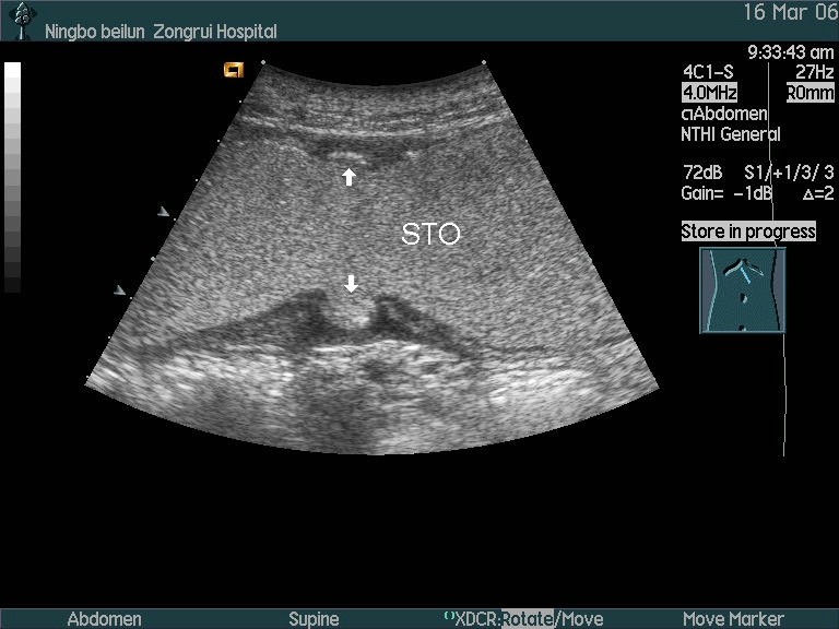 医讯:超声科胃肠超声造影检查试运行 本院职工及家属可免费检查_腾讯