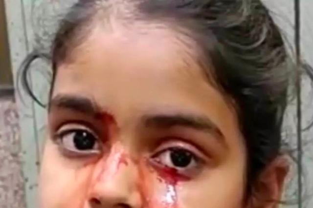 印度小女孩患怪病每天流血泪满脸血迹场景吓人却无丝毫疼痛