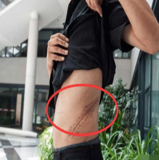 当年为买苹果4,小伙割掉自己的肾,在得到巨额赔偿之后现今如何_腾讯