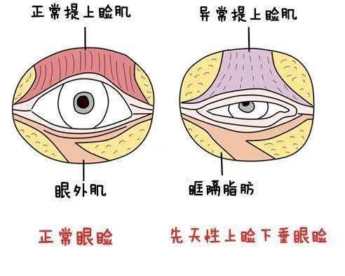 重庆小米熊胡燃燃提醒孩子眼睛睁不开无神大小眼警惕上睑下垂