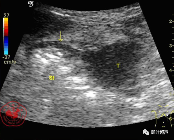 胃间质瘤的超声表现