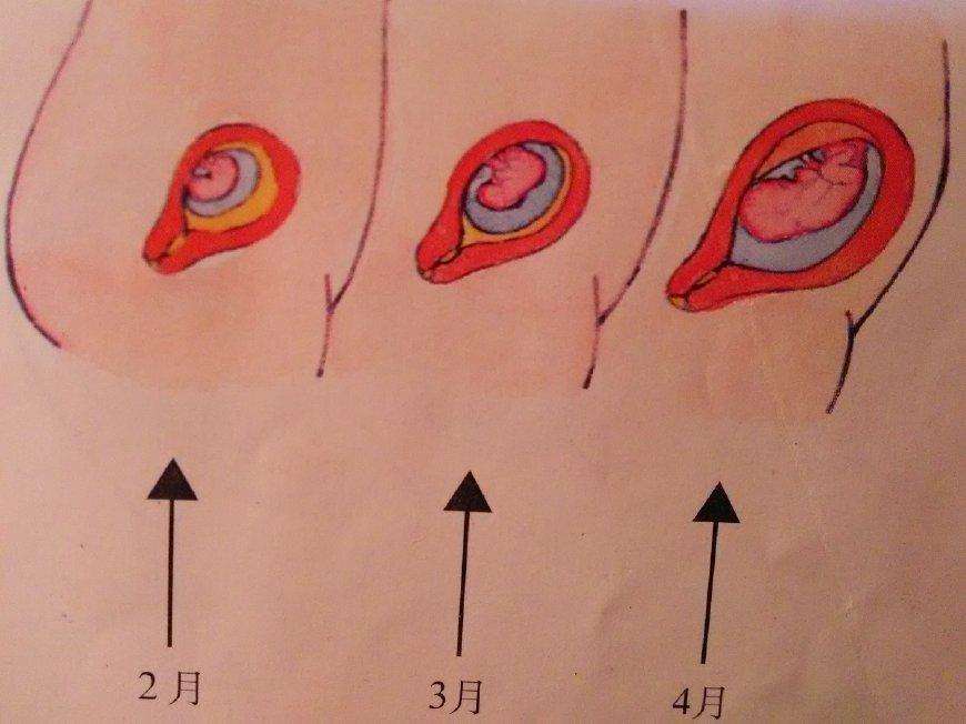 之所以会出现这样的差别主要是因为孕囊的着床位置不同