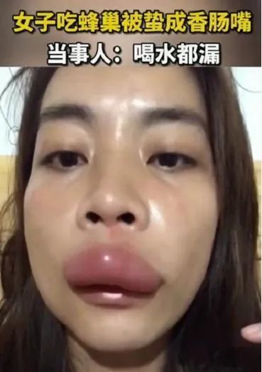 女子直播吃蜂巢被蛰成香肠嘴,真的是嘴巴嘟嘟了