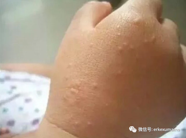化纤类品,不要用太热的水清洗;(3) 早期出现皮疹可用1-2周的激素软膏