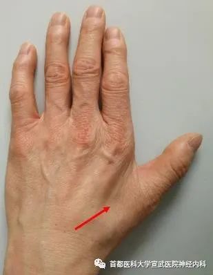 虎口没有肉警惕渐冻症