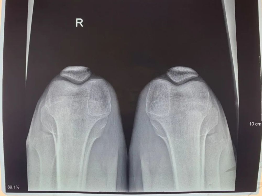 膝关节滑膜炎髌骨软化症一例治验报告