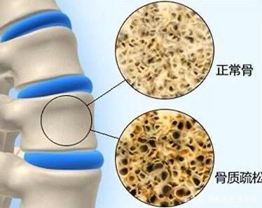 警惕人类无声的杀手骨质疏松症医生带您正确认识骨质疏松症