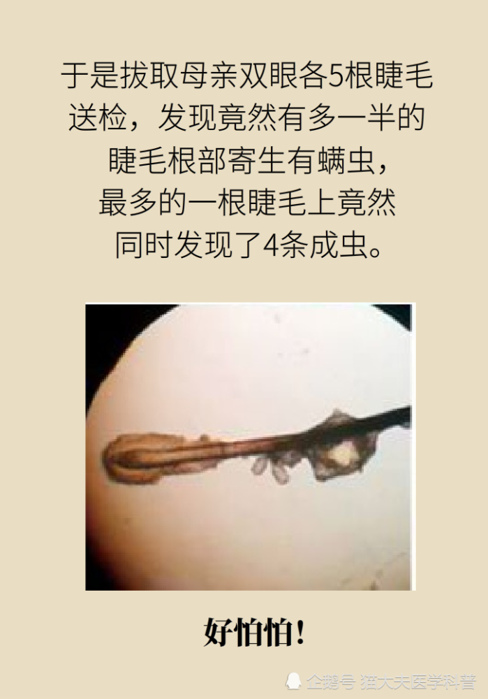 一根睫毛藏有4只螨虫你以为的沙眼没那么简单