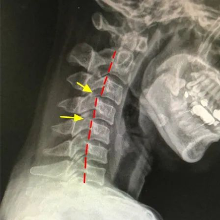 【健康】广州女子坐过山车扭伤脖子!这些人慎玩,严重可致瘫痪