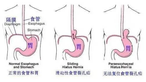 胸腔所致,通俗的來講,就是我們胸腔和腹腔之間有一個分隔層,叫膈肌