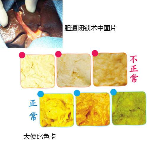 胆道闭锁对患儿都有哪些影响_腾讯新闻