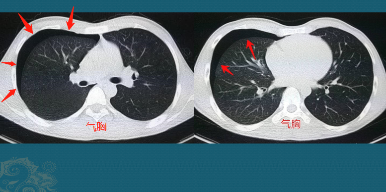 尖部外围常见一些小肺大泡,这些大泡受气流冲击破裂是造成气胸的病因