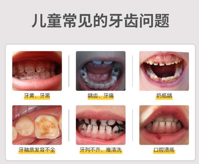 3岁宝宝有龋齿管不管别把乳牙不当回事小心影响孩子未来恒牙