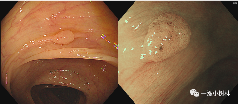 结肠息肉图谱 内镜集锦_腾讯新闻