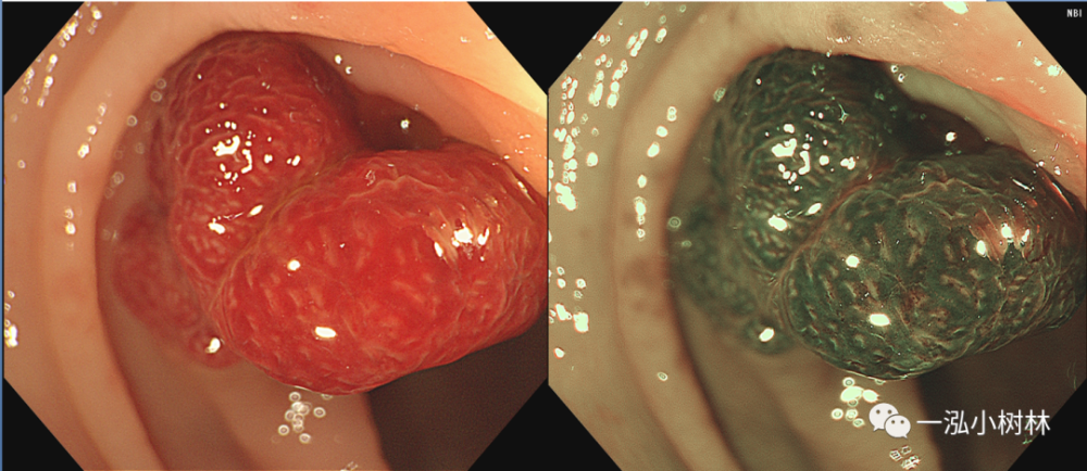 结肠息肉图谱 内镜集锦_腾讯新闻