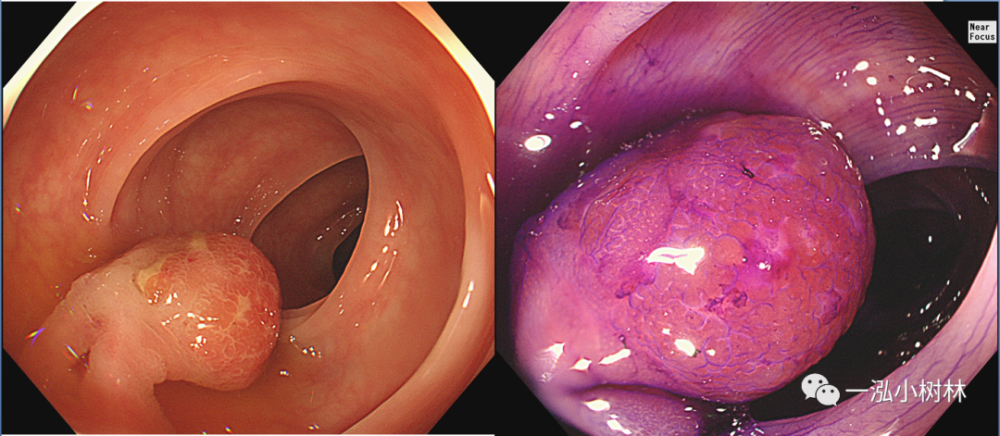 iiil型)图8 结肠炎性息肉 (pit pattern ii型)图7 结肠增生性息肉(pit