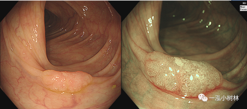 结肠息肉图谱 内镜集锦_腾讯新闻