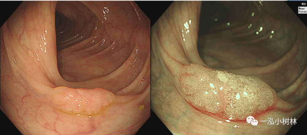 结肠nbi分类 内镜集锦_腾讯新闻