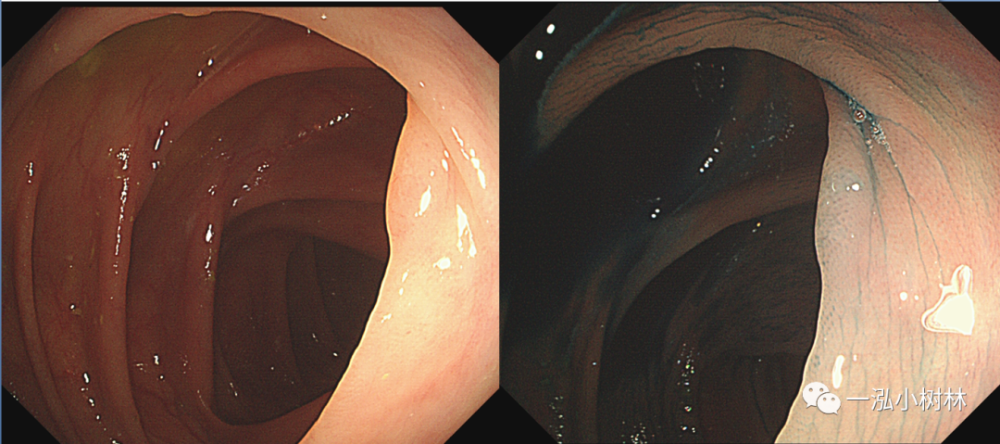 结肠息肉图谱 内镜集锦_腾讯新闻