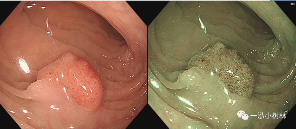 结肠息肉图谱 内镜集锦_腾讯新闻
