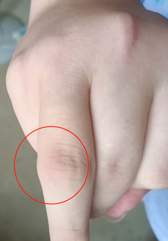 检查发现,小陈的尿酸值远远高出正常水平,他的手脚关节增粗,肉眼可见