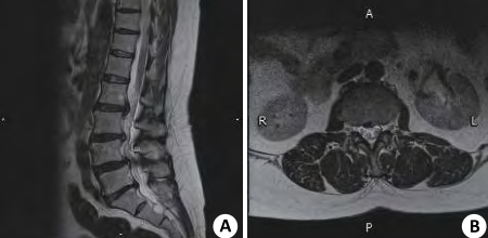 四个诊断腰椎管狭窄的mri征象 千万不能忽视 腾讯新闻