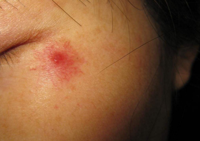 肝癌早期不声不响面部这3个表现其实已经很明显