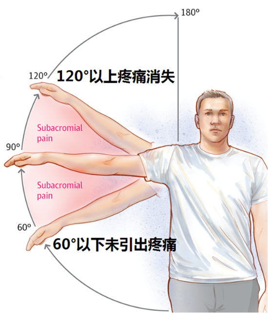 撞击征:neer撞击征,hawkins撞击征疼痛弧:患者外展肩关节60度至90度时