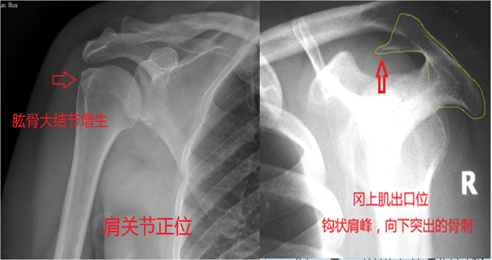 常见是肩峰撞击综合征_腾讯新闻