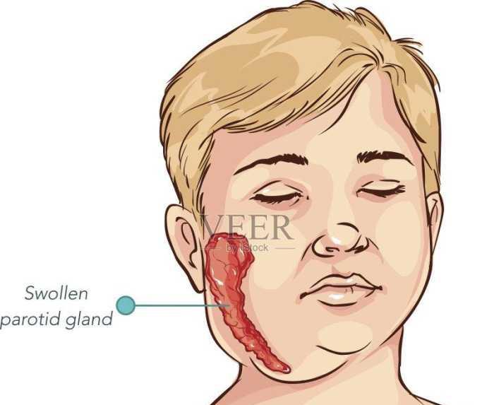 腮腺炎的症状初期图片