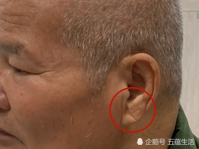 虽然不能百分之百断定「对角线耳垂折线」与心脏疾病有直接关联,但