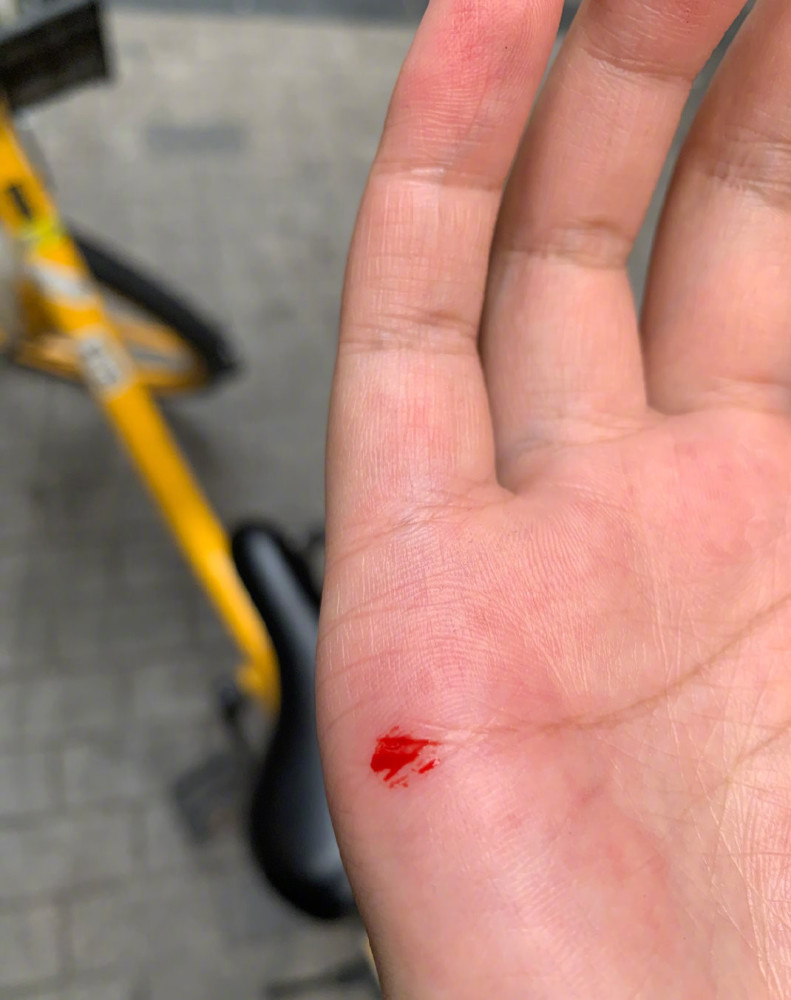 共享单车座椅"带刺",成都一女子扎破手,担心传染做系列检查!