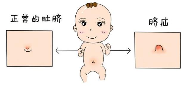脐疝,俗称"气肚脐",属易复性疝,是一种先天发育缺陷.