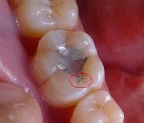 经常塞牙又如何解决呢?_腾讯新闻