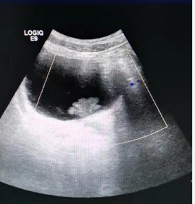 膀胱占位一定是肿瘤吗?