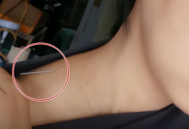 她从医院回家后持续疼痛了两个小时,一摸肩膀,才发现有银针一直扎在
