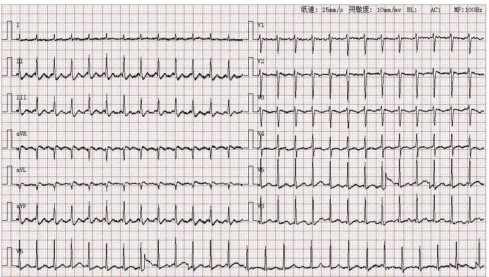 第1056期 房扑伴过速