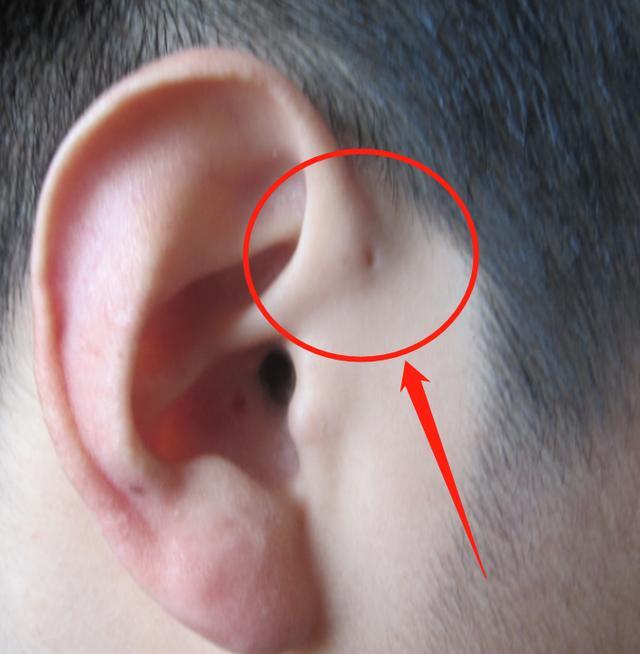 为啥有些新生儿耳朵会有"孔"?究竟是好是坏?父母自己要知道
