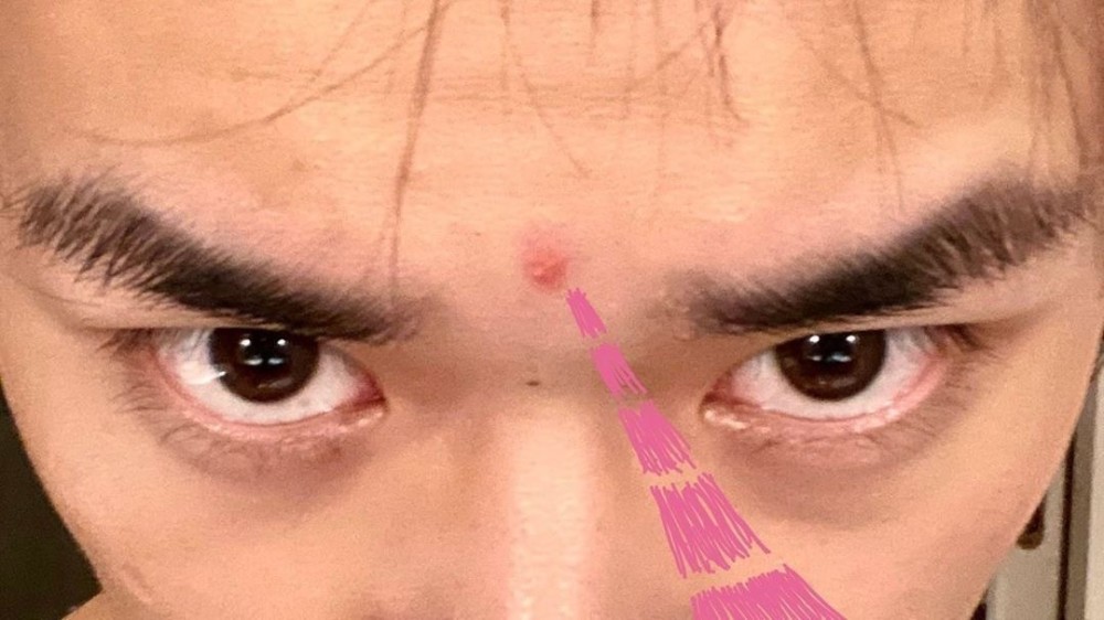 易烊千玺爆痘,在线撒娇!