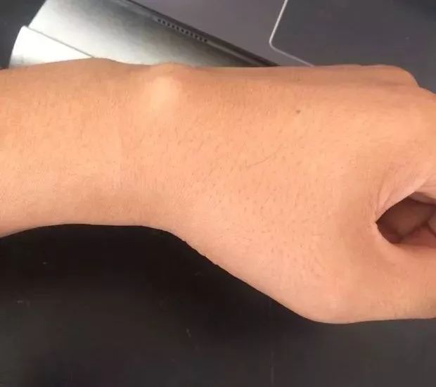 腕部软组织发炎,腕部骨折,关节炎等,都会刺激囊肿在几天内迅速增生