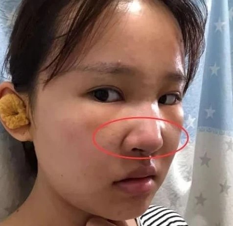 挤鼻子上的黑头