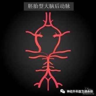 胚胎型大脑后动脉