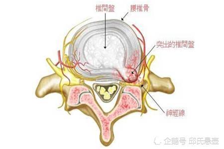 邱氏悬壶诊断腰椎间盘突出的常用方法是什么