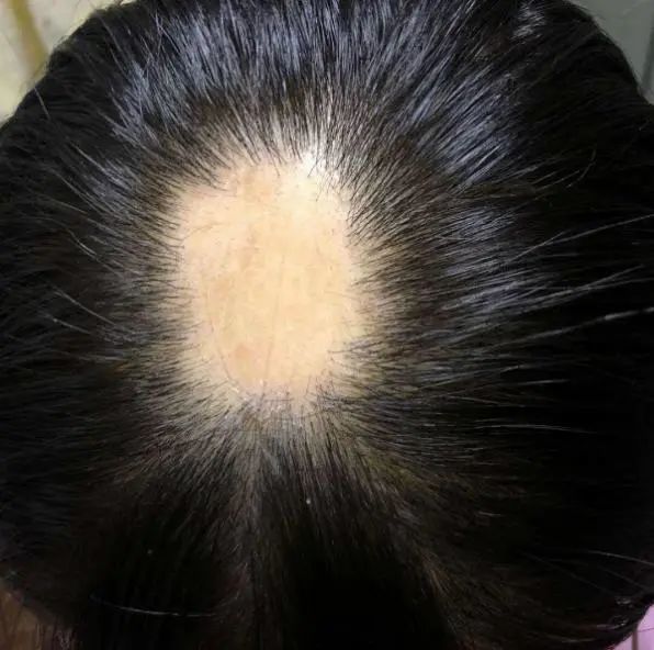 斑秃,是一种 非瘢痕性脱发,常发生于身体有毛发的部位,局部皮肤正常