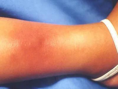 "你这症状,考虑淋巴管炎.