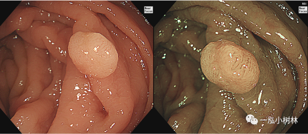 腺瘤(pit pattern iiil型 cf-hq290i a7 b7)图34 结肠绒毛管状腺瘤 hg